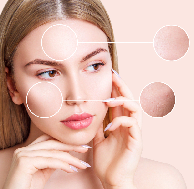 Magnifying,Circles,Demonstrate,Problem,Skin,With,Postacne,Of,Young,Woman. Le carbon peel pour améliorer l'apparence et la texture de la peau du visage